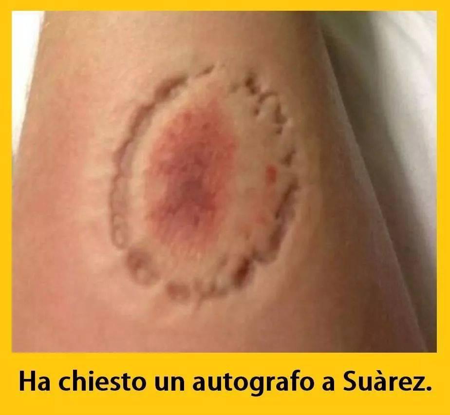 Segno di un morso in un braccio